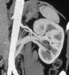 Retroaortic Left Renal Vein - CTisus CT Scan