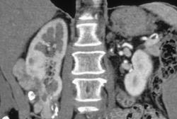 Renal Cell Carcinoma - CTisus CT Scan