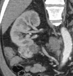 Renal Cell Carcinoma - CTisus CT Scan