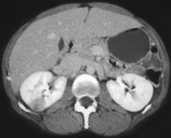 Acute Pyelonephritis - CTisus CT Scan