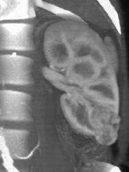 Renal Cell Carcinoma - CTisus CT Scan