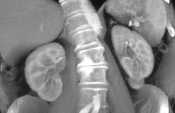 Incidental Left Renal Wall Carcinoma - CTisus CT Scan
