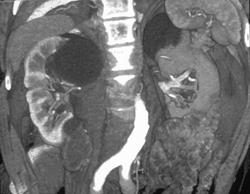Lower Pole Carcinoma of the Right Kidney - CTisus CT Scan