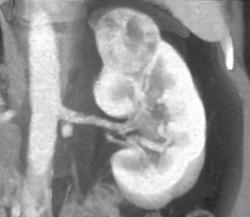 2 Phase Renal Wall Carcinoma - CTisus CT Scan