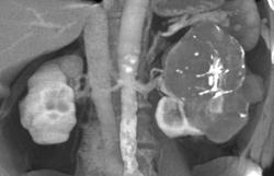 Renal Cell Carcinoma - CTisus CT Scan
