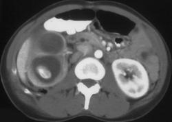 Pyonephrosis Right Kidney - CTisus CT Scan