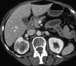 Transitional Cell Carcinoma Right Kidney - CTisus CT Scan