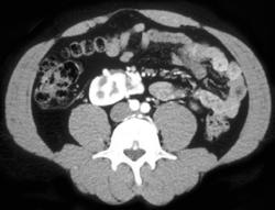 Malrotated Right Kidney - CTisus CT Scan