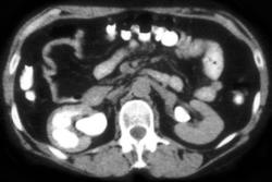 Chronic Pyelonephritis With Dilated Calyces in Right Kidney - CTisus CT Scan