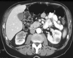 Renal Metastases From Lung Cancer - CTisus CT Scan