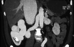 Renal Arteriovenous Malformation (AVM) - CTisus CT Scan