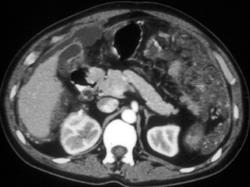 Retroperitoneal Sarcoma Simulates Renal Mass - CTisus CT Scan