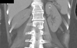 Renal Cyst - CTisus CT Scan