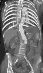 Right Perirenal Hematoma - CTisus CT Scan