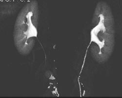 Normal CT Urogram - CTisus CT Scan