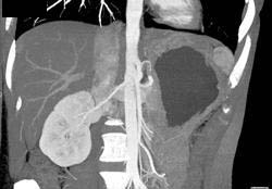 Normal Right Kidney - CTisus CT Scan