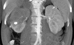 Right Sided Transitional Cell Carcinoma - CTisus CT Scan
