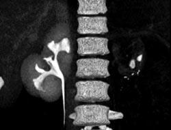 Atrophic Left Kidney - CTisus CT Scan