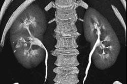 Normal Kidneys - CTisus CT Scan