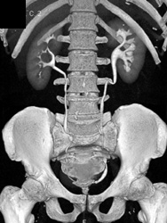 Mild Left Hydronephrosis - CTisus CT Scan