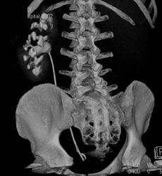Ureteropelvic Junction (UPJ) Obstruction - CTisus CT Scan