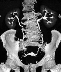 Enlarged Prostate - CTisus CT Scan