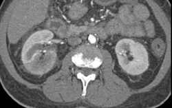 Acute Pyelonephritis - CTisus CT Scan