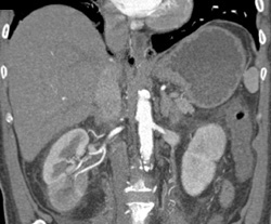 Acute Pyelonephritis - CTisus CT Scan
