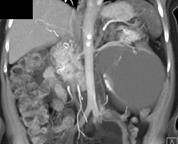 Large Renal Cyst - CTisus CT Scan