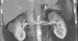 Renal Cell Carcinoma (left) - CTisus CT Scan