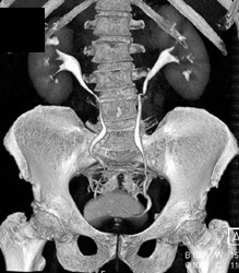 Normal CT Urogram - CTisus CT Scan