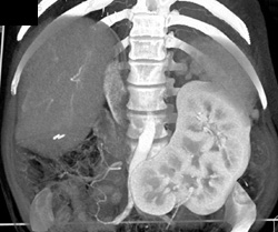 Crossed Renal Ectopic - CTisus CT Scan