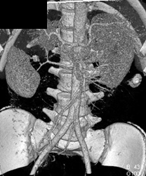 Renal Laceration - CTisus CT Scan