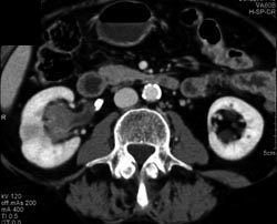 Transitional Cell Carcinoma - CTisus CT Scan
