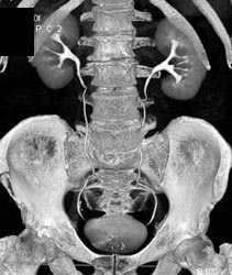 Normal CT Urogram - CTisus CT Scan