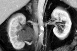 Delayed Nephrogram Right Kidney Due to Obstruction - CTisus CT Scan