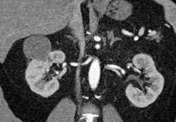 Cystic Renal Cell Carcinoma - CTisus CT Scan