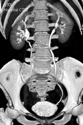 Ct Urogram - CTisus CT Scan