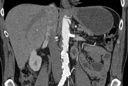 Patent Renal Artery Stent - CTisus CT Scan