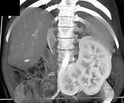 Crossed Renal Ectopia - CTisus CT Scan