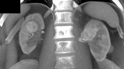 Bilateral Vascular Renal Masses - CTisus CT Scan