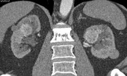 Bilateral Renal Masses - CTisus CT Scan