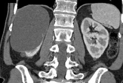 Renal Cyst - CTisus CT Scan