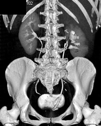 Ct Urogram With Chronic Pyelonephritis - CTisus CT Scan