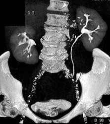 Ct Urogram - CTisus CT Scan