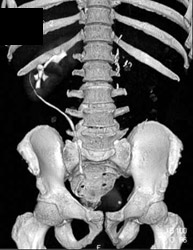 Malrotated Kidneys - CTisus CT Scan
