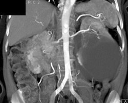Obstructed Left Ureter - CTisus CT Scan