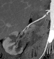 Renal Artery Stenosis - CTisus CT Scan