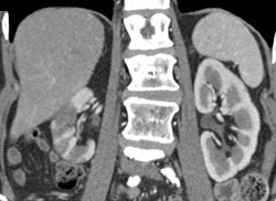 Acute Pyelonephritis - CTisus CT Scan