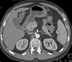 Renal Calculi Seen on Early Phase Imaging - CTisus CT Scan